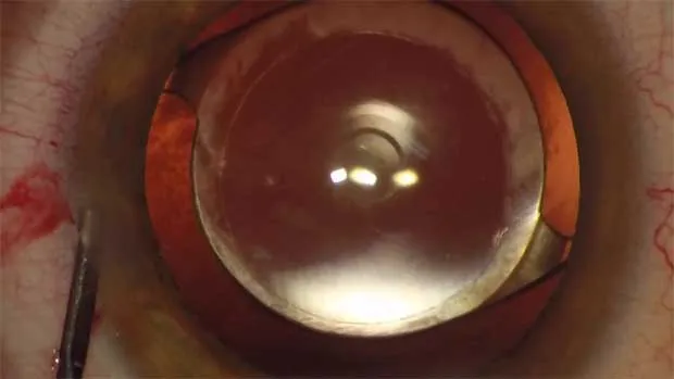 Alcon presenta Vivity la primera Lente Intraocular que corrige la