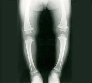 rayos x de raquitismo